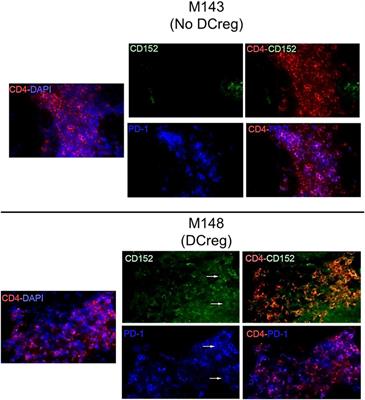 Donor-Derived Regulatory Dendritic Cell Infusion Maintains Donor-Reactive CD4+CTLA4hi T Cells in Non-Human Primate Renal Allograft Recipients Treated with CD28 Co-Stimulation Blockade